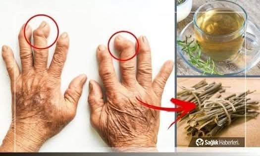 İltihaplı Eklem Romatizmasına Ne İyi Gelir