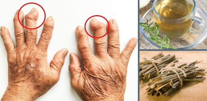 İltihaplı eklem romatizması Romatoid Artrit