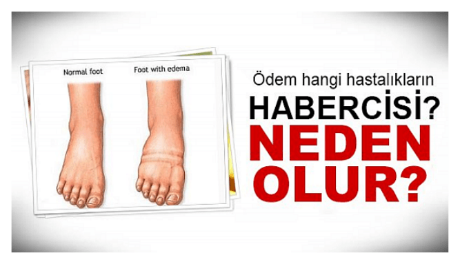 Ödem Hastalık Habercisi