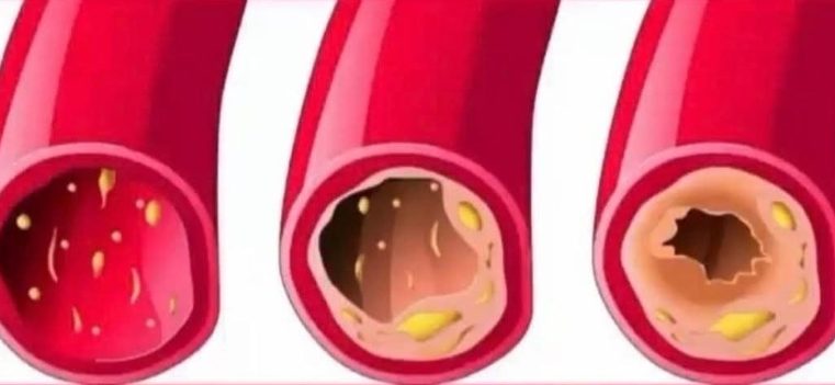 Damar Tıkanıklığını Önleyen Gıdalar