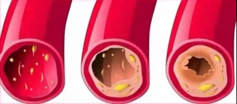 Damar Tıkanıklığını Önleyen Gıdalar