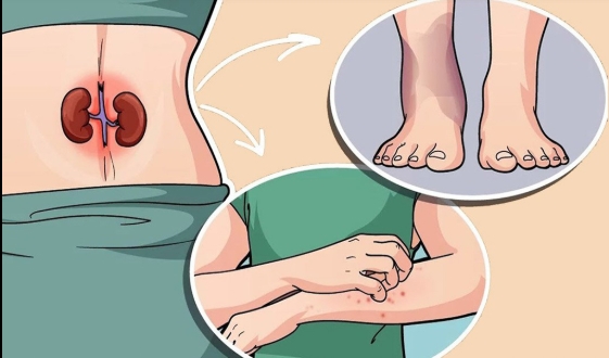 Böbrek Hastalığının 7 Belirtisi