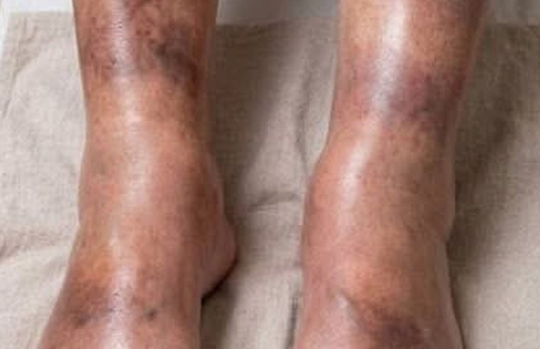 Sessiz sinyal Şişmiş bacaklarınız