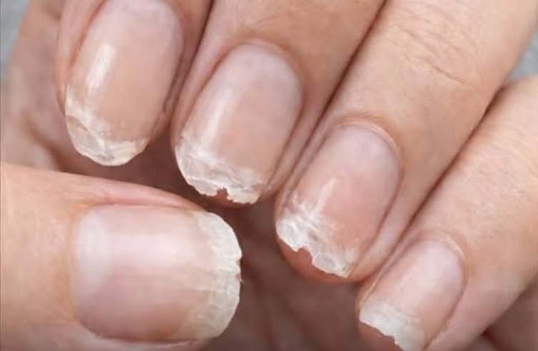 Tırnaklarınızın Sizi Uyarmaya Çalıştığı 7 Hayat Değiştirici Hastalığı Açıklıyor