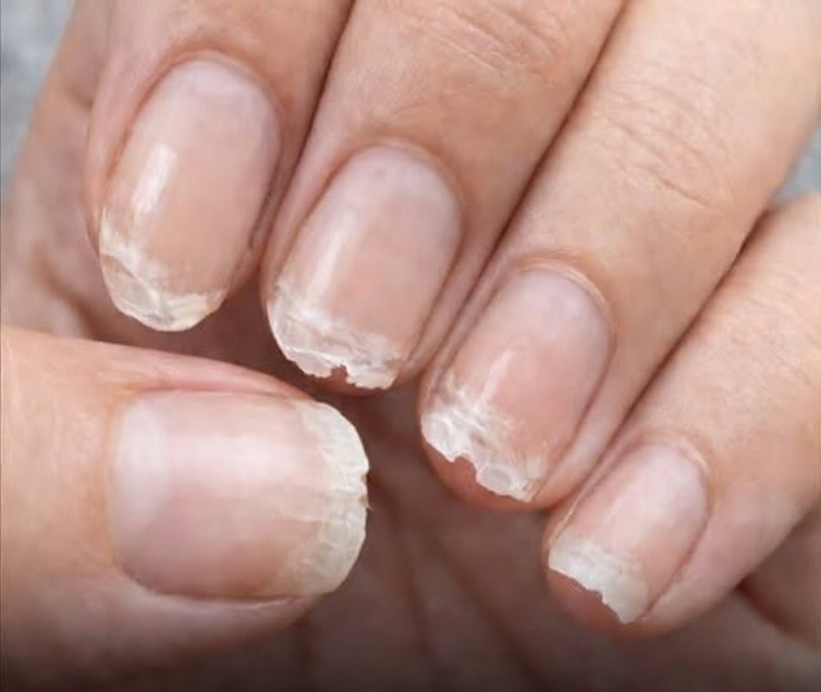 Tırnaklarınızın Sizi Uyarmaya Çalıştığı 7 Hayat Değiştirici Hastalığı Açıklıyor