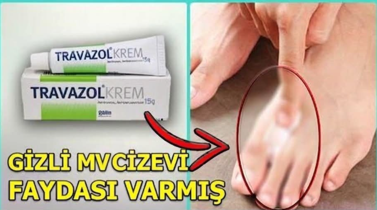 Travazol krem nedir ve nerelerde kullanılır