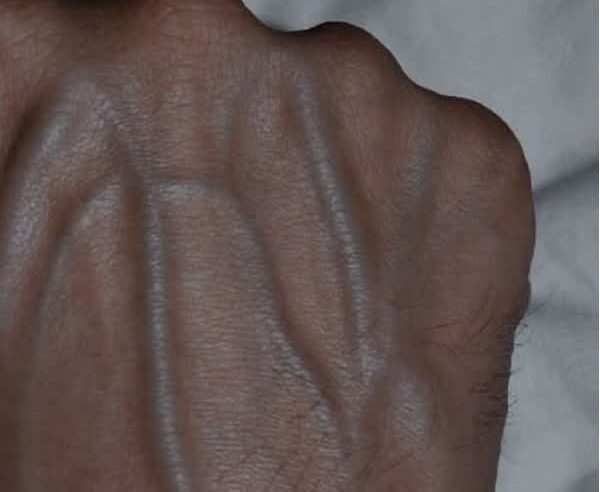 Görünür Damarlar Ne Anlama Gelir